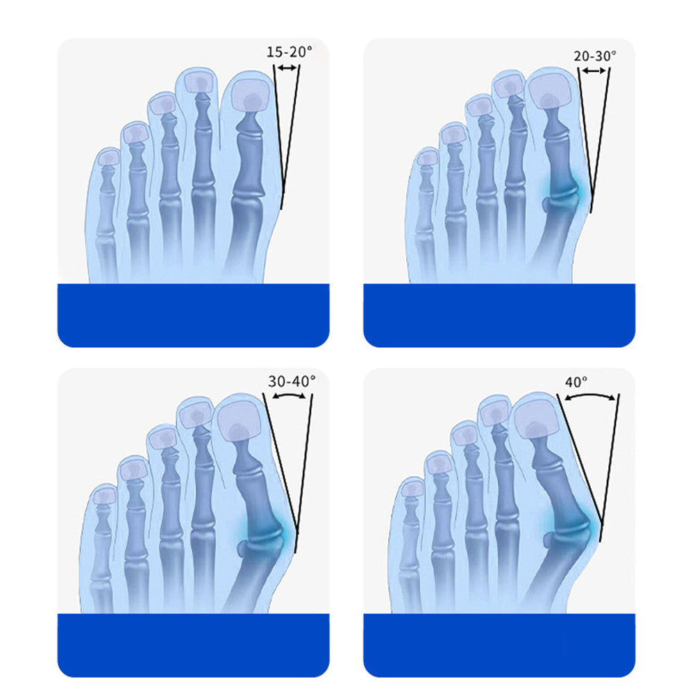 Bunion Corrector Toe